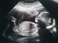 baby scan